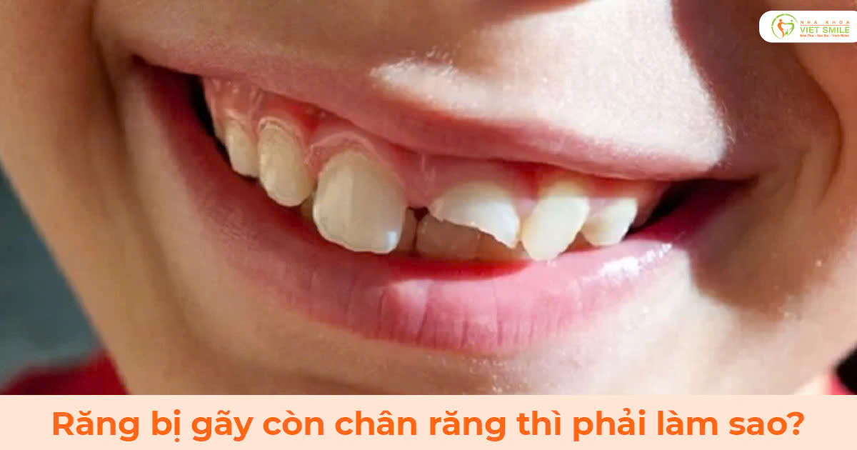 Răng bị gãy còn chân răng thì phải làm sao?