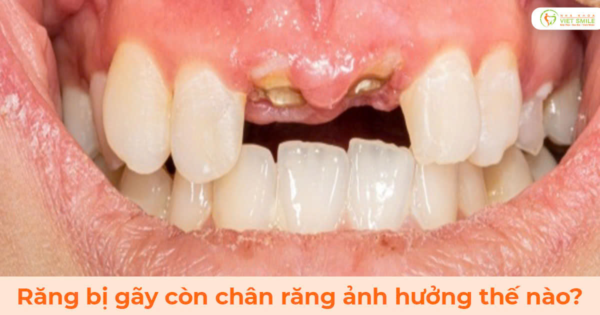 Răng bị gãy còn chân răng ảnh hưởng thế nào?