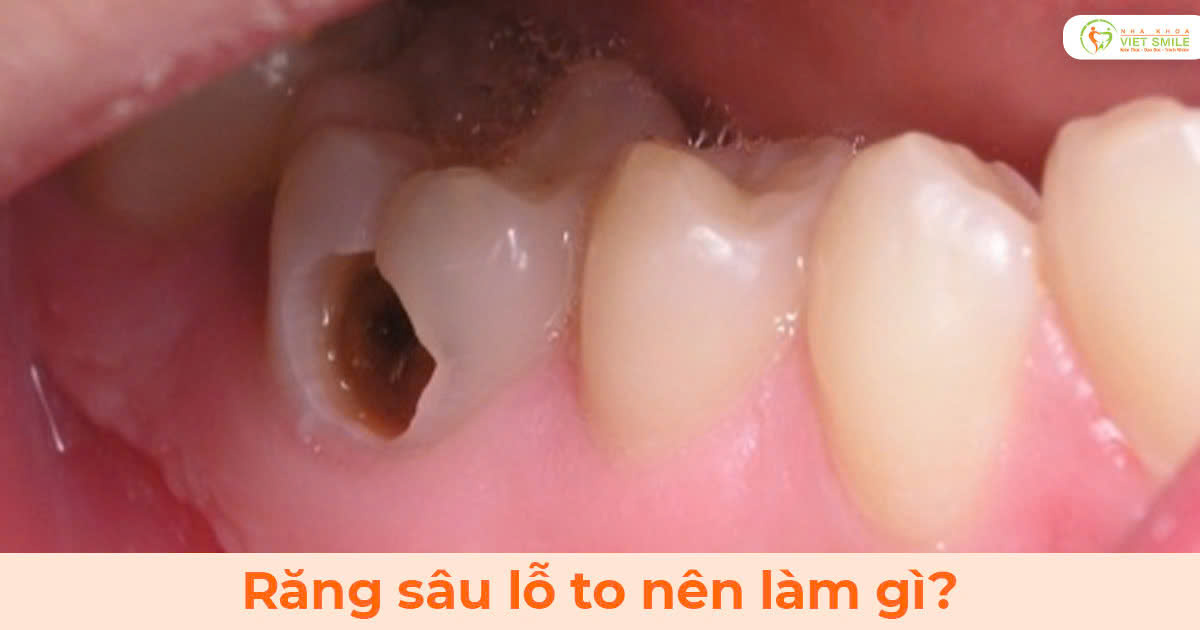 Răng sâu lỗ to nên làm gì?