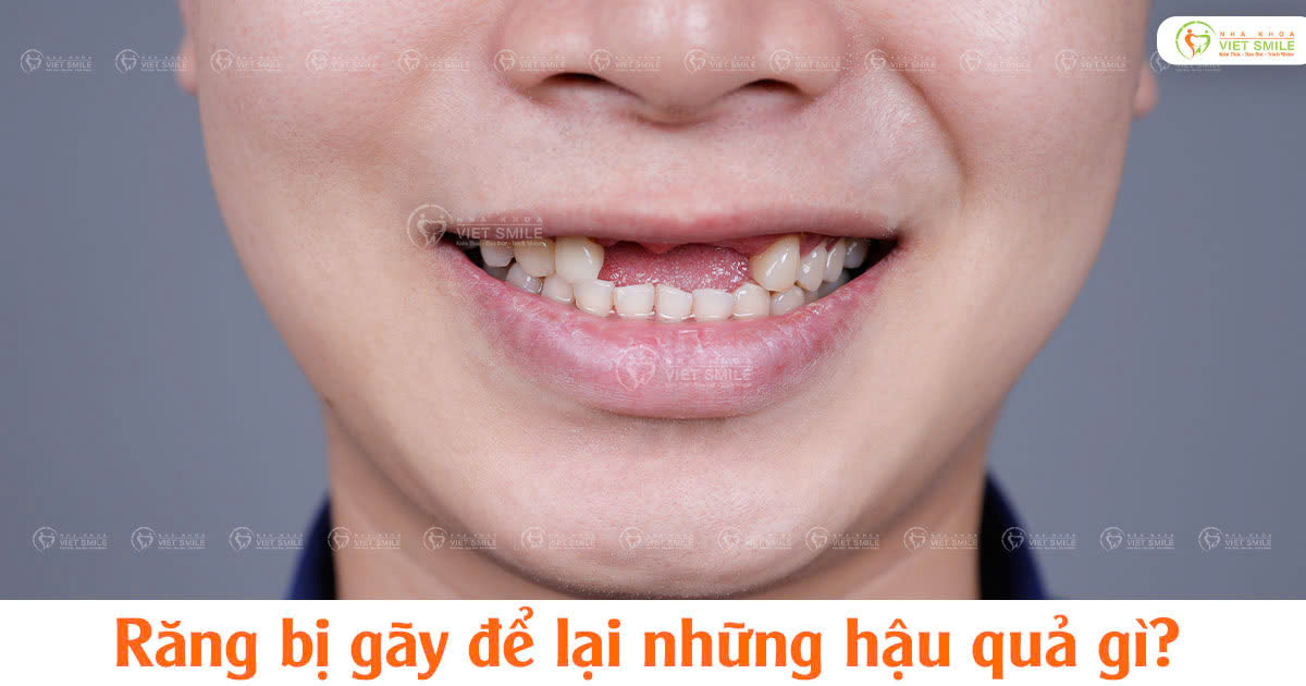 Răng bị gãy để lại những hậu quả gì?