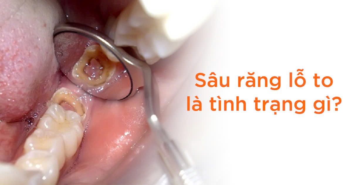 Sâu răng lỗ to là tình trạng gì?