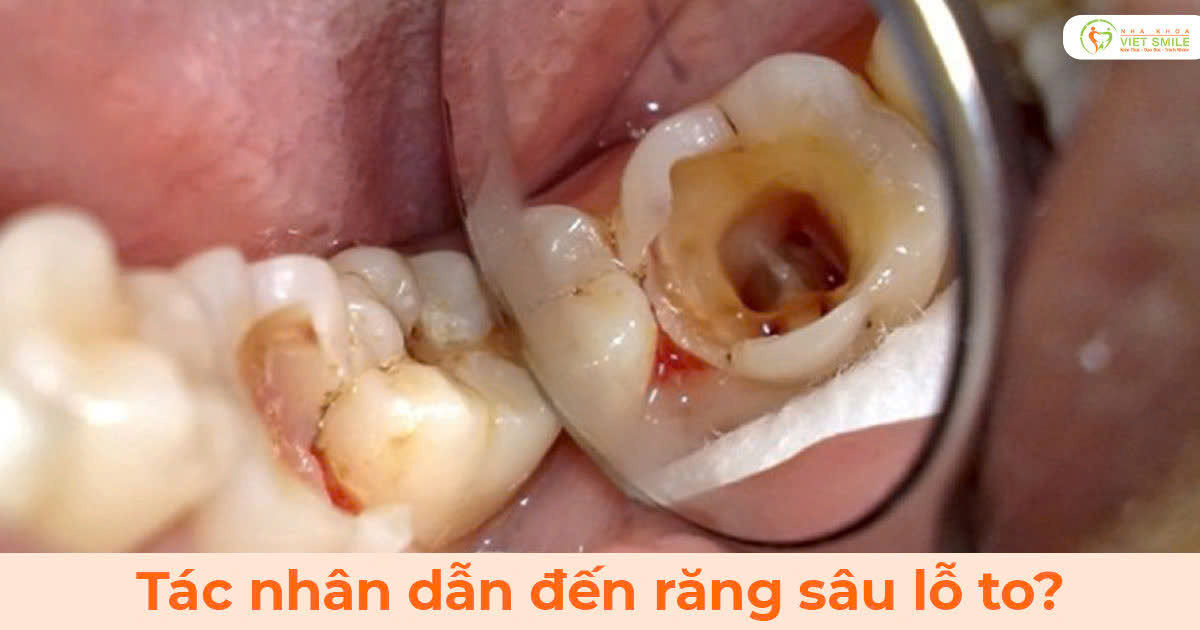 Tác nhân dẫn đến răng sâu lỗ to?