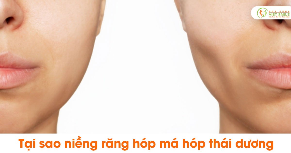 Tại sao niềng răng hóp má hóp thái dương