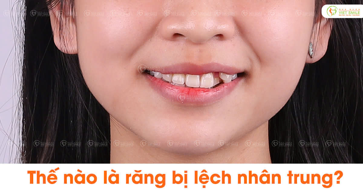 Thế nào là răng bị lệch nhân trung?