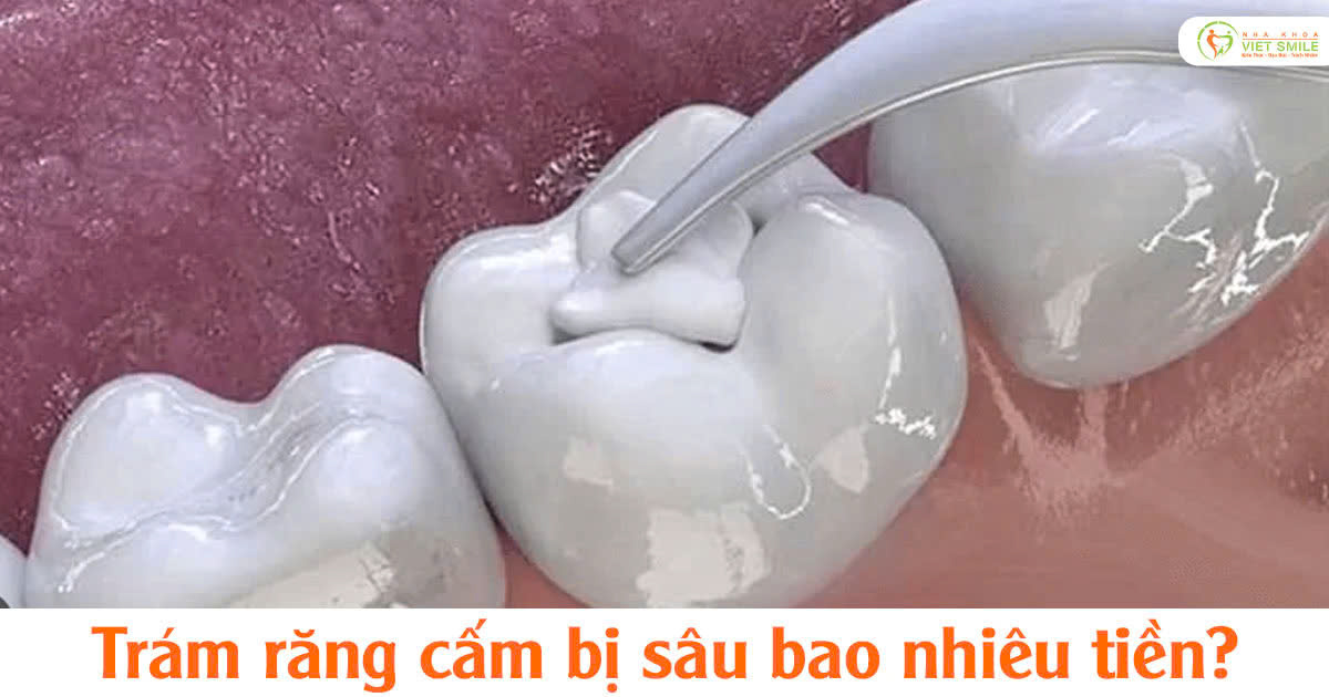 Trám răng cấm bị sâu bao nhiêu tiền?