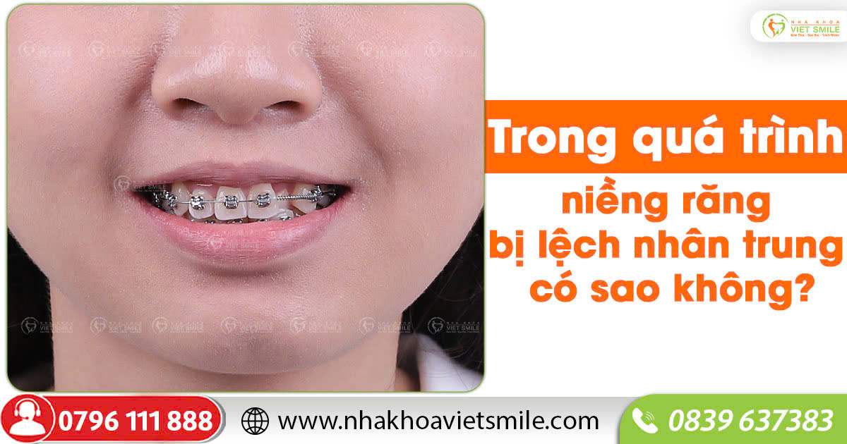 Trong quá trình niềng răng bị lệch nhân trung có sao không?