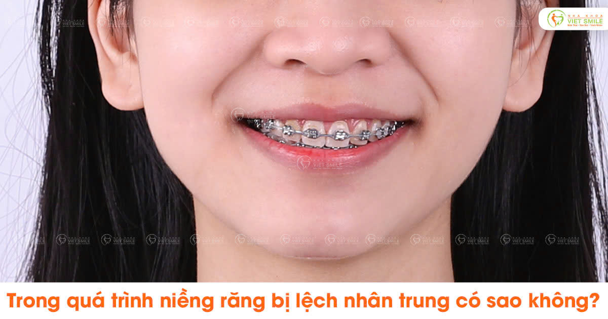 Trong quá trình niềng răng bị lệch nhân trung có sao không?