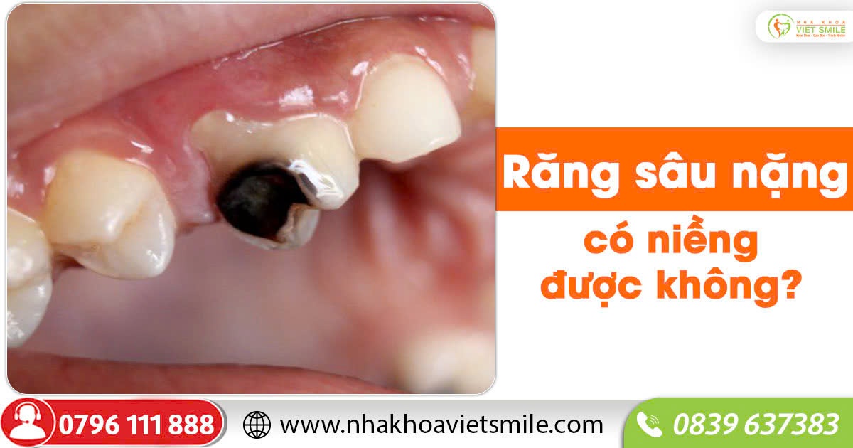 Răng sâu nặng có niềng được không?