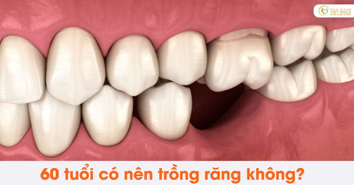 60 tuổi có nên trồng răng không?