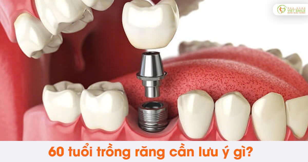 60 tuổi trồng răng cần lưu ý gì?