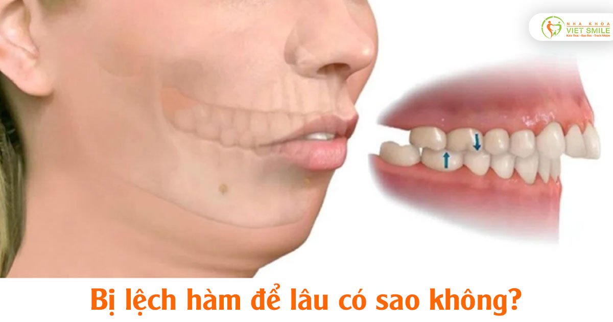 Bị lệch hàm để lâu có sao không?