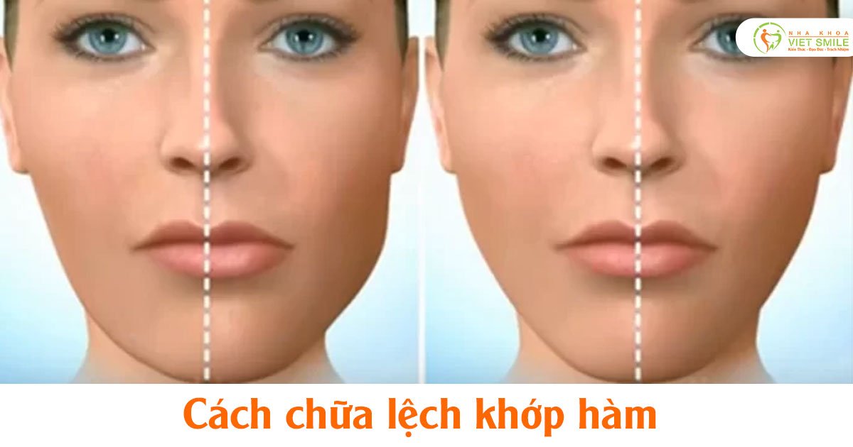 Cách chữa lệch khớp hàm