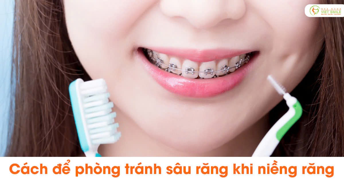 Cách để phòng tránh sâu răng khi niềng răng