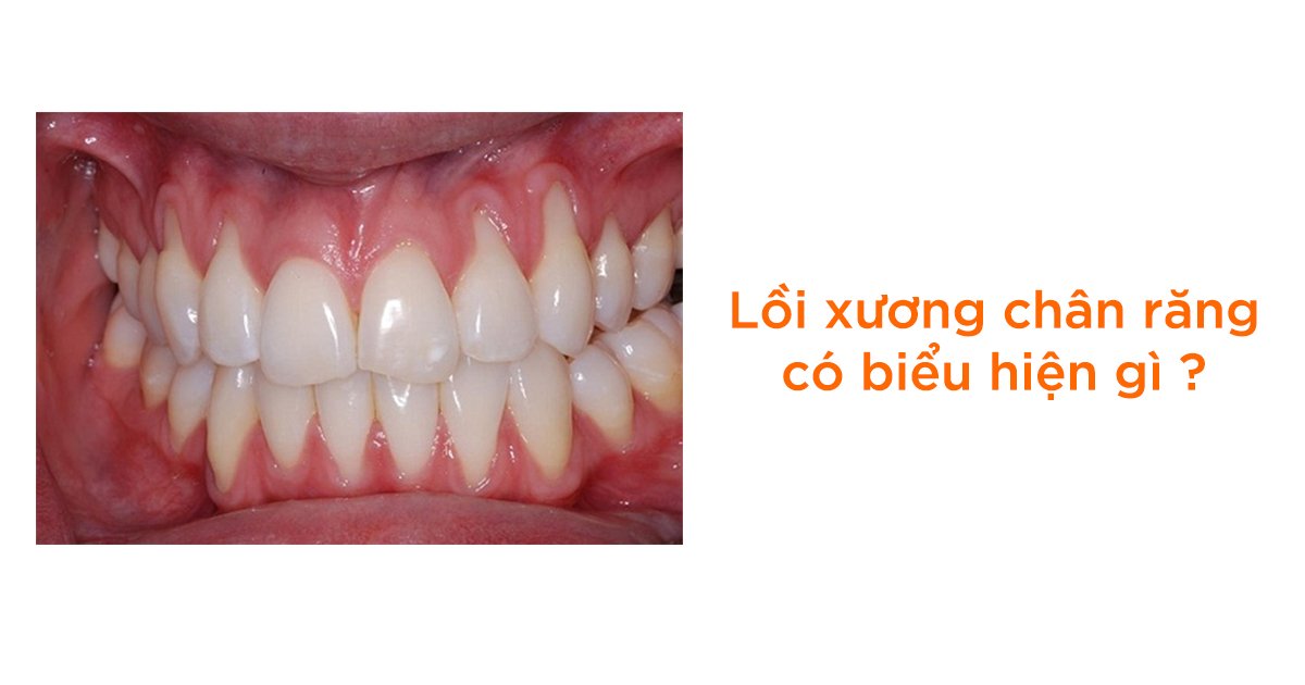 Lồi xương chân răng có biểu hiện gì?