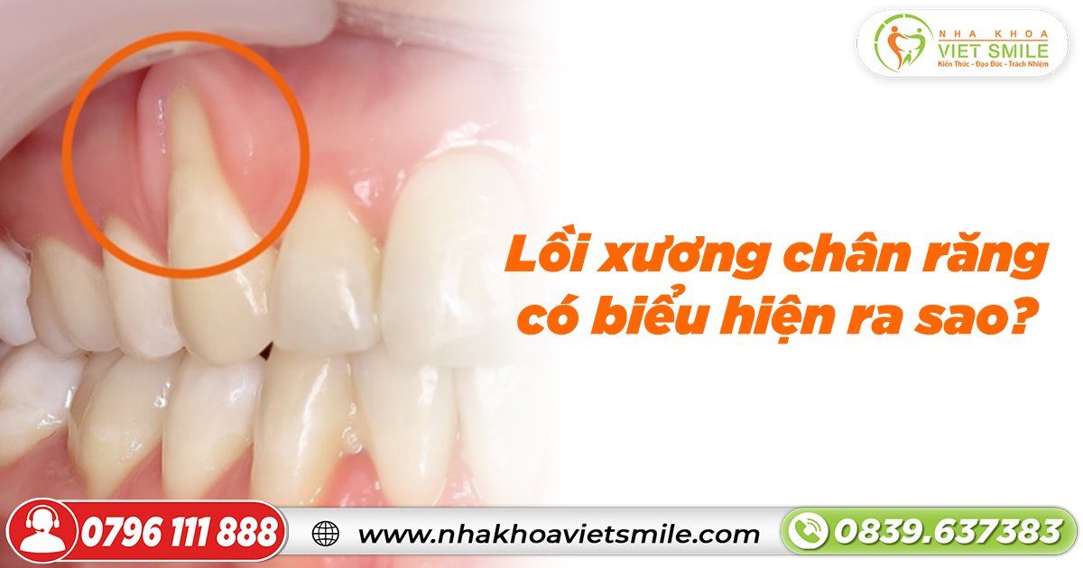 Lồi xương chân răng có biểu hiện ra sao?