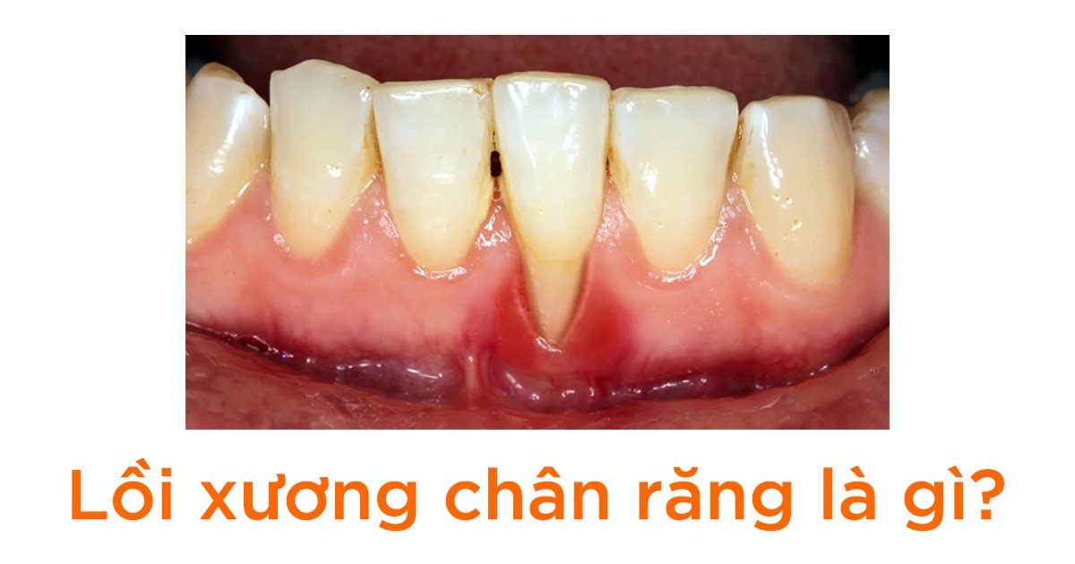 Lồi xương chân răng là gì?