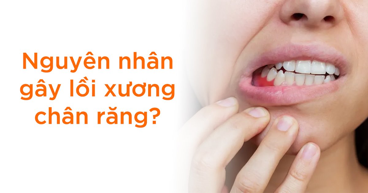 Nguyên nhân nào gây lồi xương chân răng?