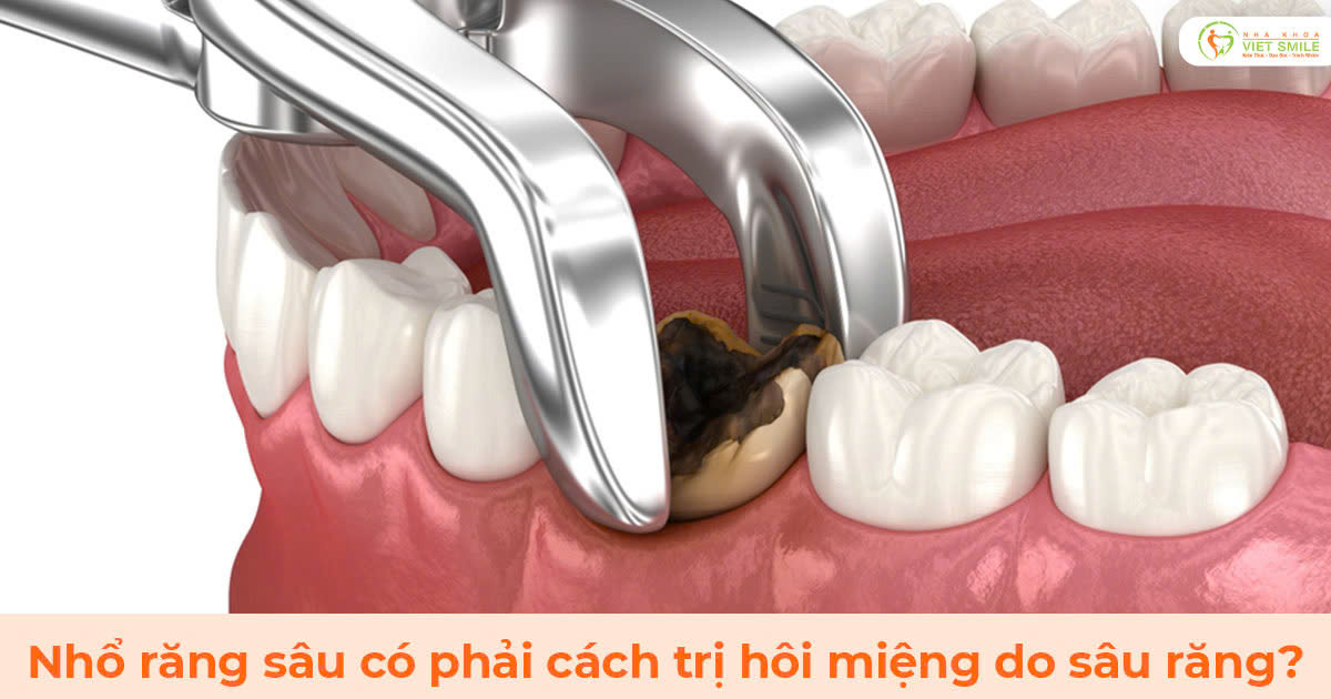 Nhổ răng sâu có phải cách trị hôi miệng do sâu răng?