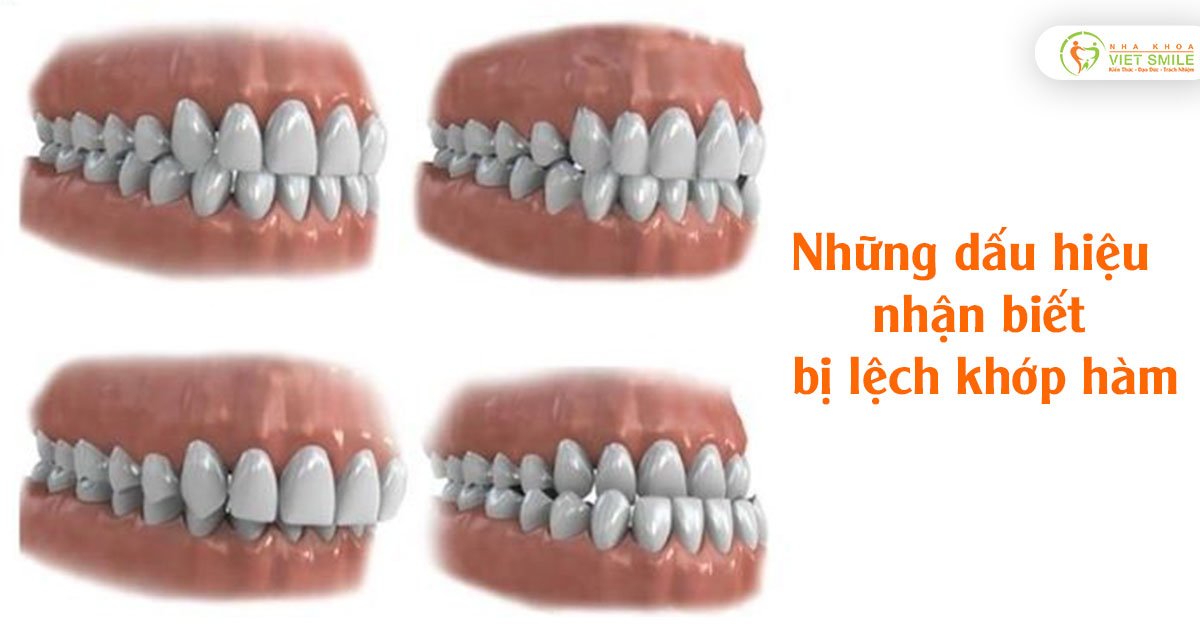 Những dấu hiệu nhận biết bị lệch khớp hàm