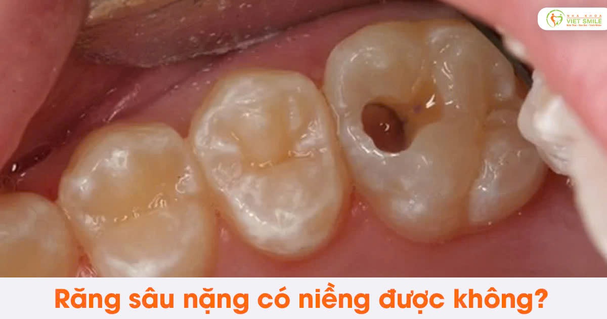 Răng sâu nặng có niềng được không?