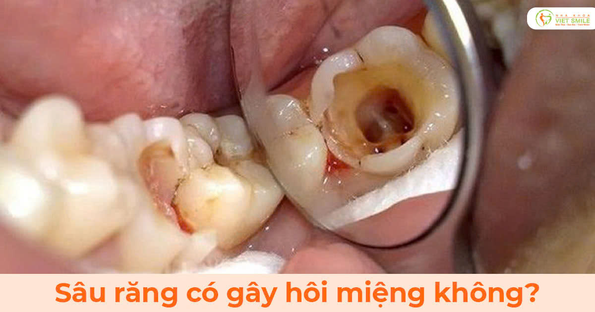 Sâu răng có gây hôi miệng không?