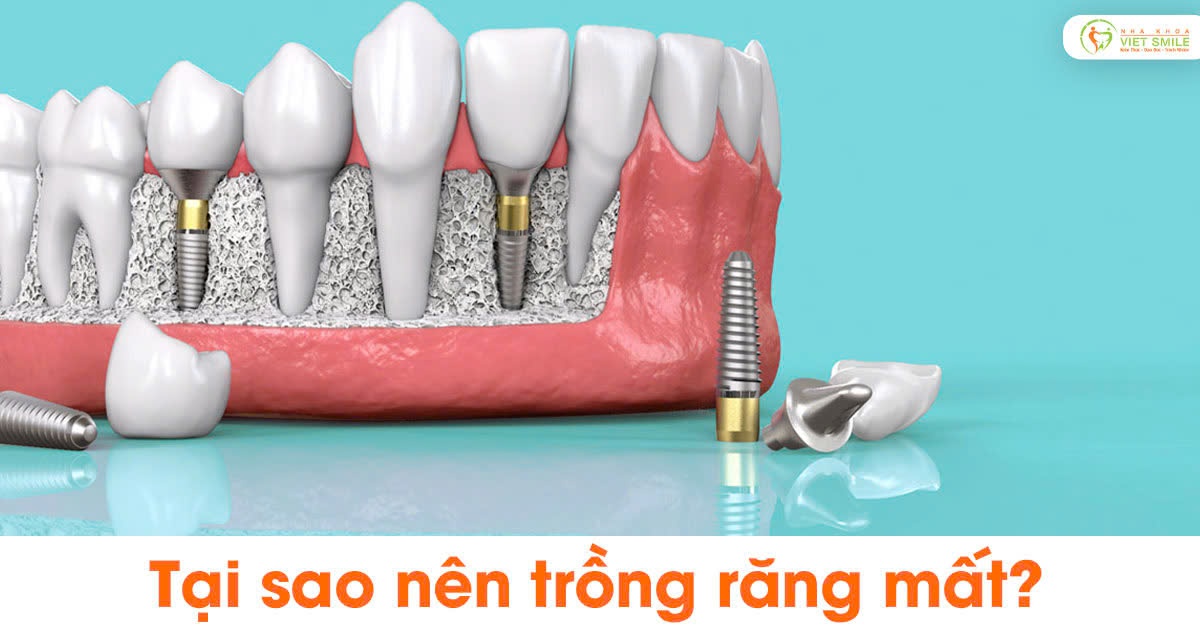 Tại sao nên trồng răng mất?