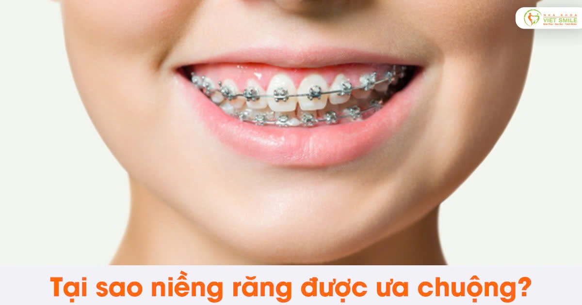 Tại sao niềng răng được ưa chuộng?