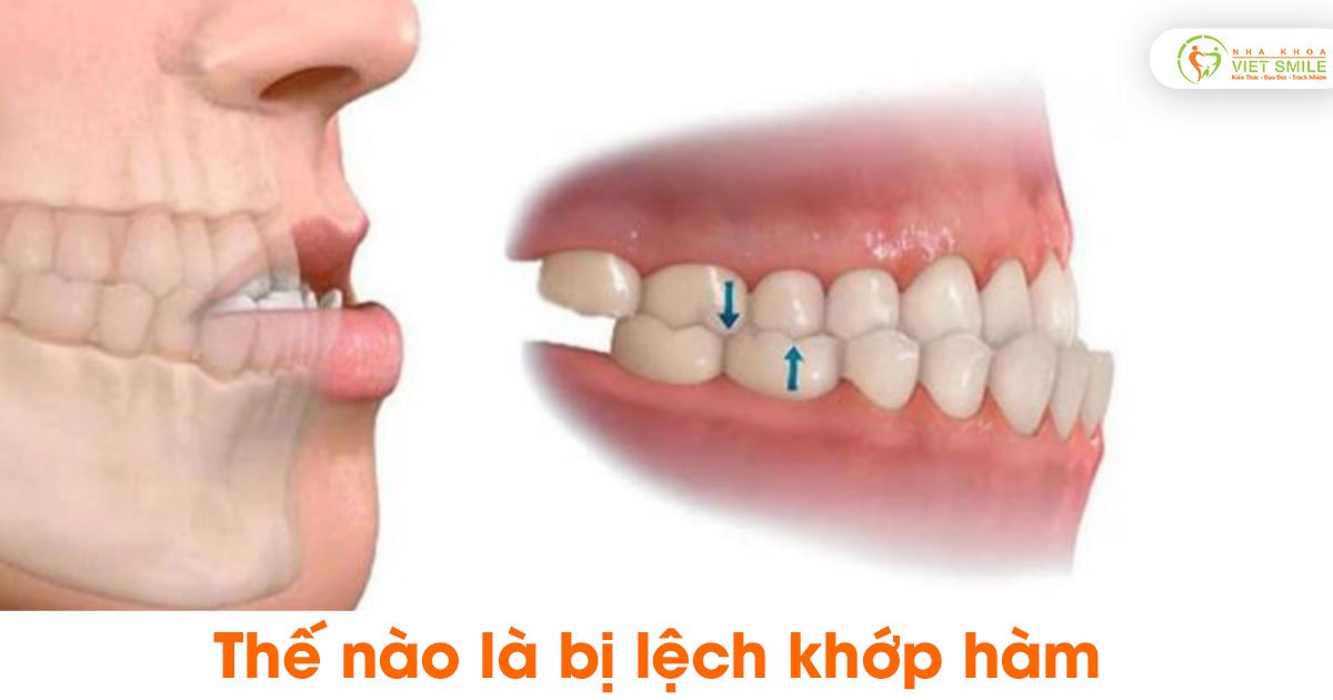 Thế nào là bị lệch khớp hàm