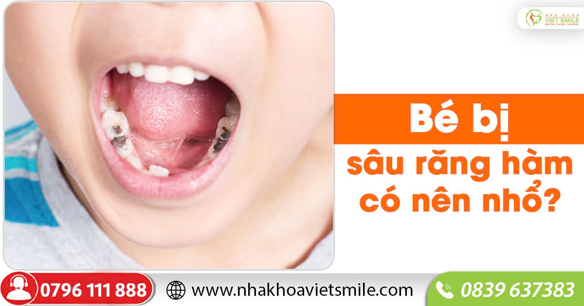 Bé bị sâu răng hàm có nên nhổ?