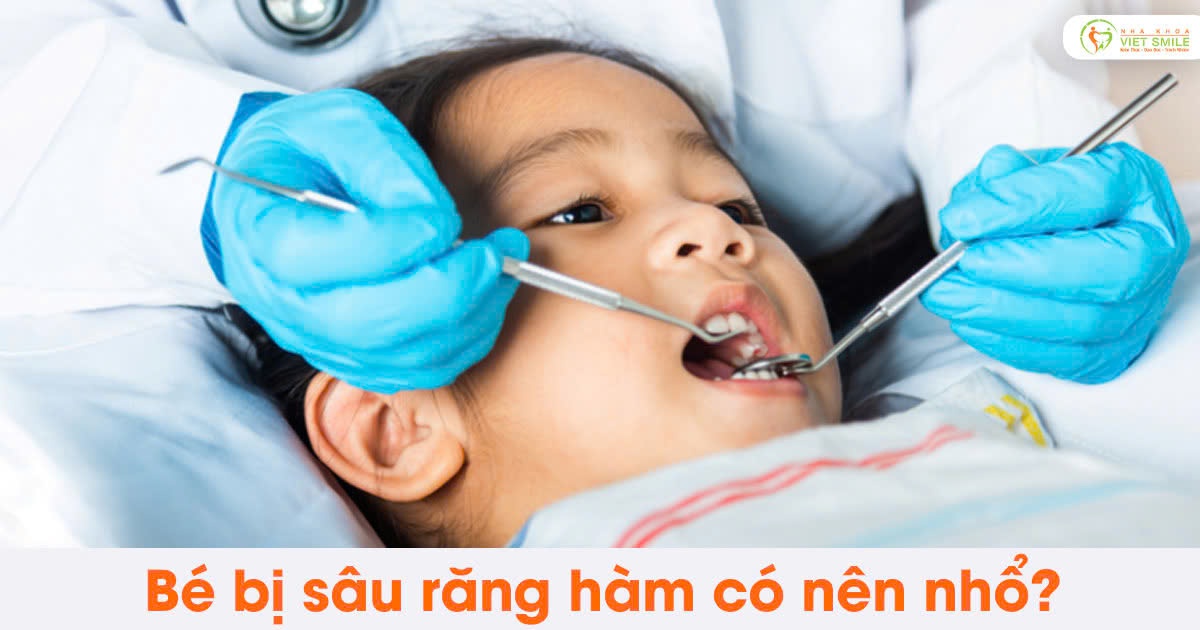 Bé bị sâu răng hàm có nên nhổ?