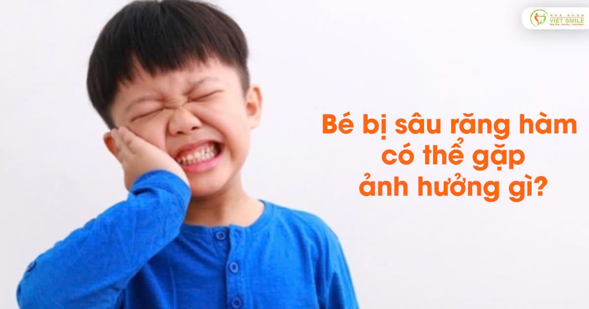 Bé bị sâu răng hàm có thể gặp ảnh hưởng gì?