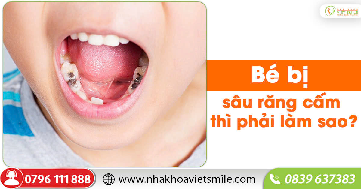 Bé bị sâu răng cấm thì phải làm sao?