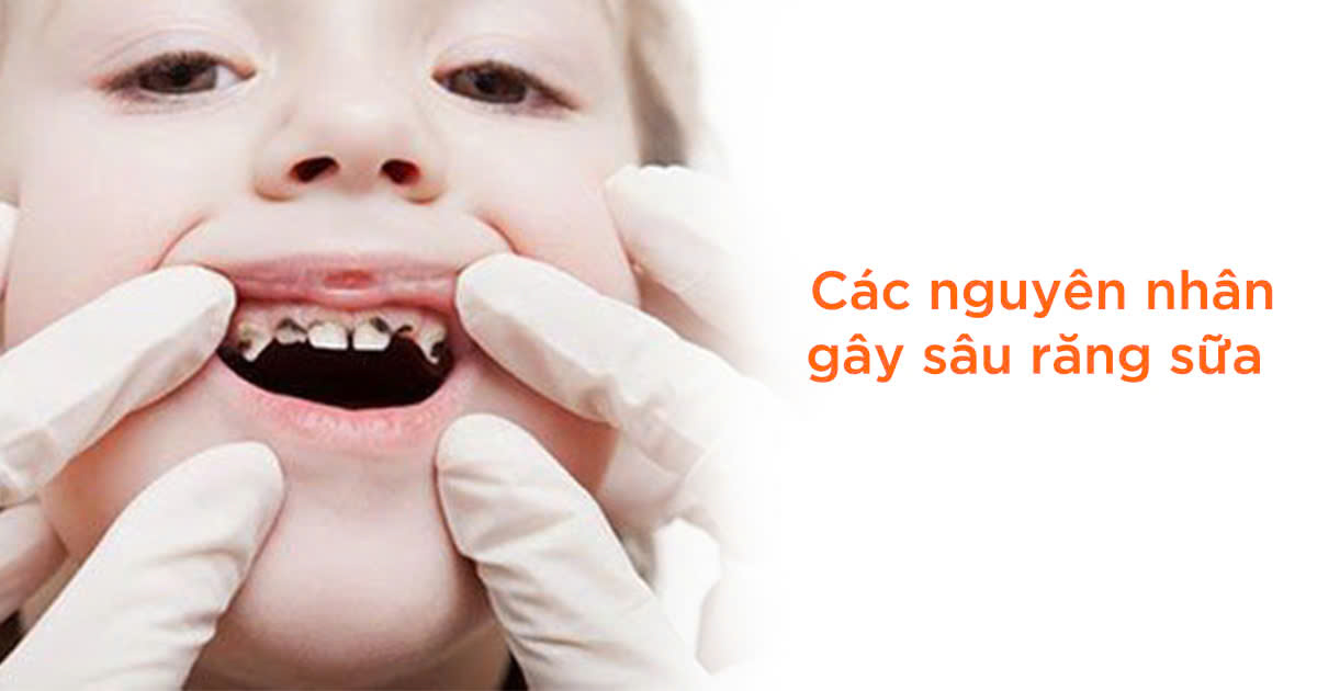 Các nguyên nhân gây sâu răng sữa