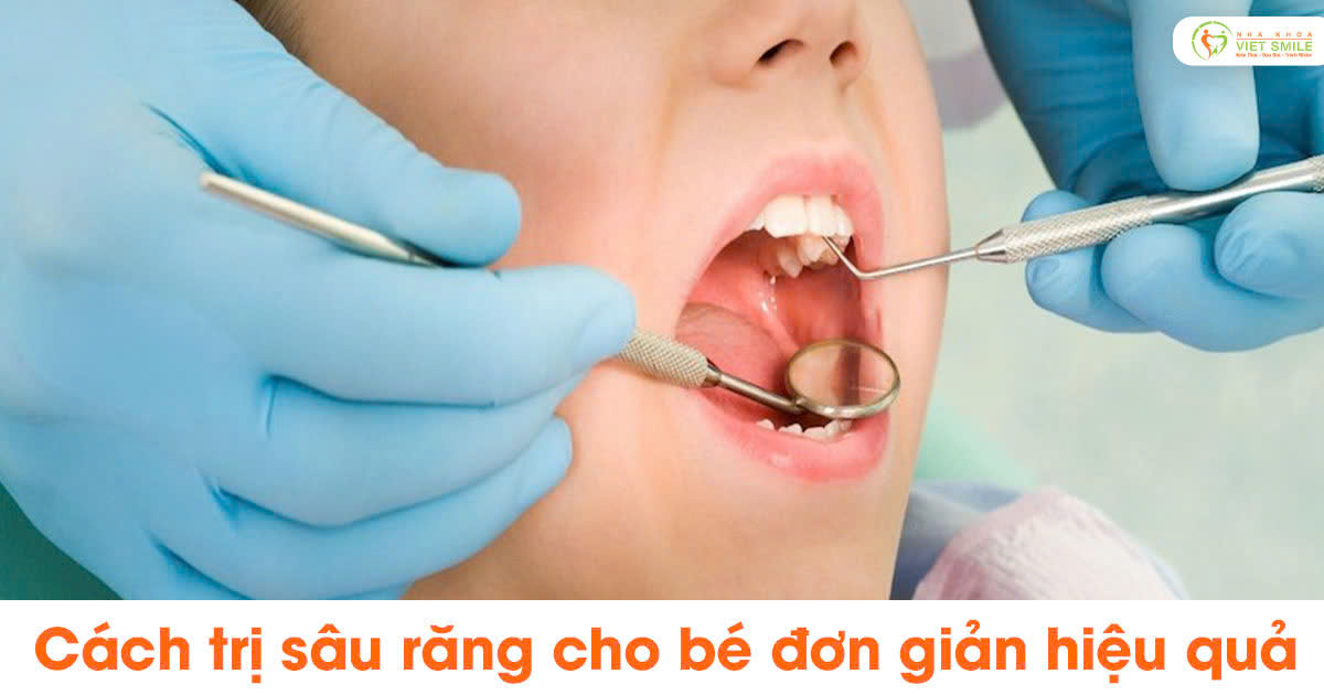 Cách trị sâu răng cho bé đơn giản hiệu quả