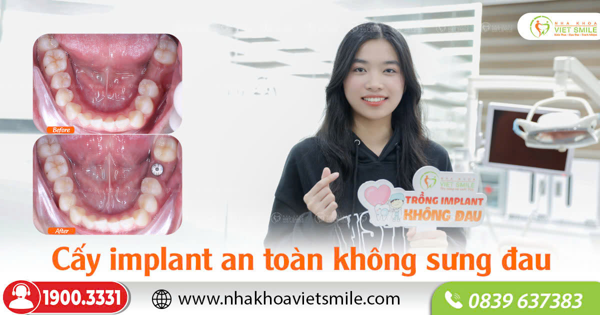 Cấy implant không sưng, đau 