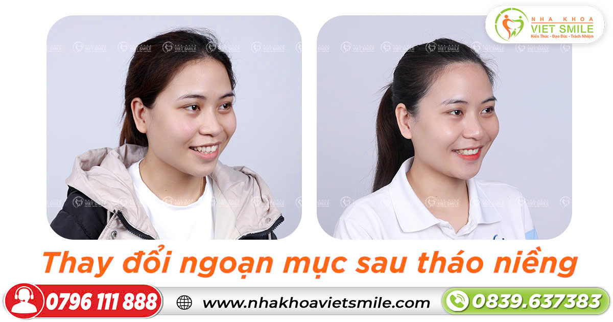 Thay đổi ngoạn mục sau niềng