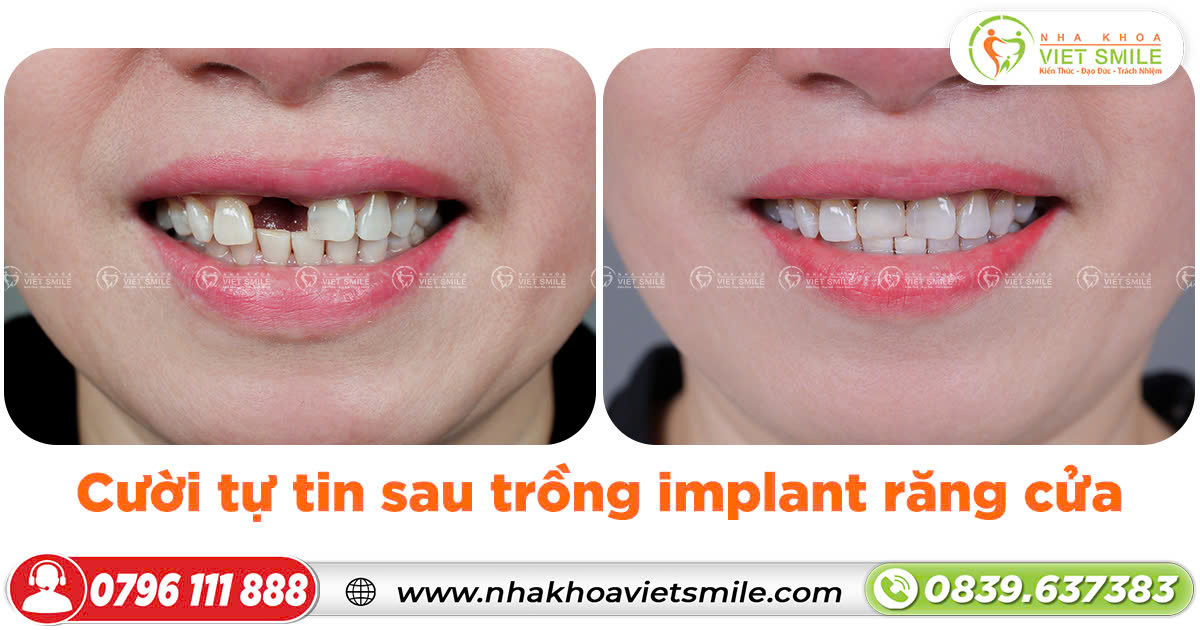 Cười tự tin sau trồng implant răng cửa