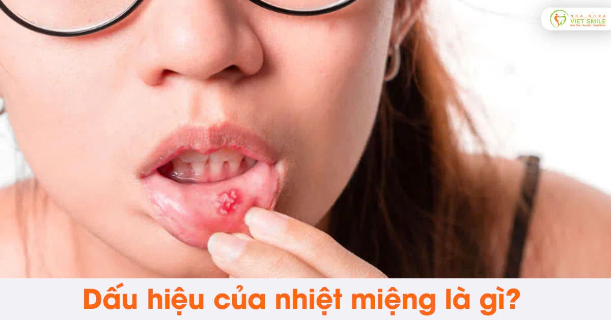 Dấu hiệu của nhiệt miệng là gì?