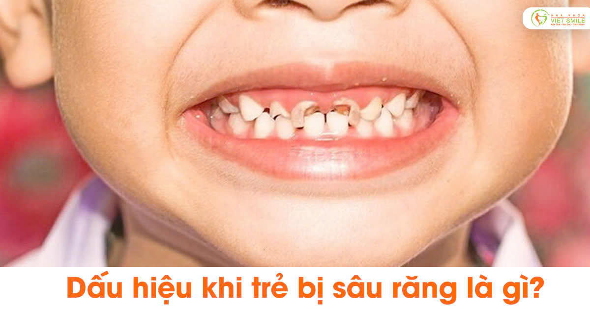 Dấu hiệu khi trẻ bị sâu răng là gì?