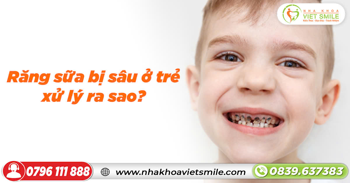 Em bé bị sâu răng nào, theo các giai đoạn nào?