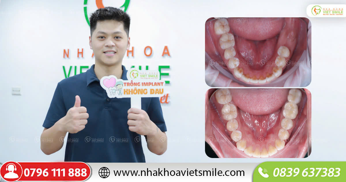 Hàm răng đầy đủ sau cấy implant