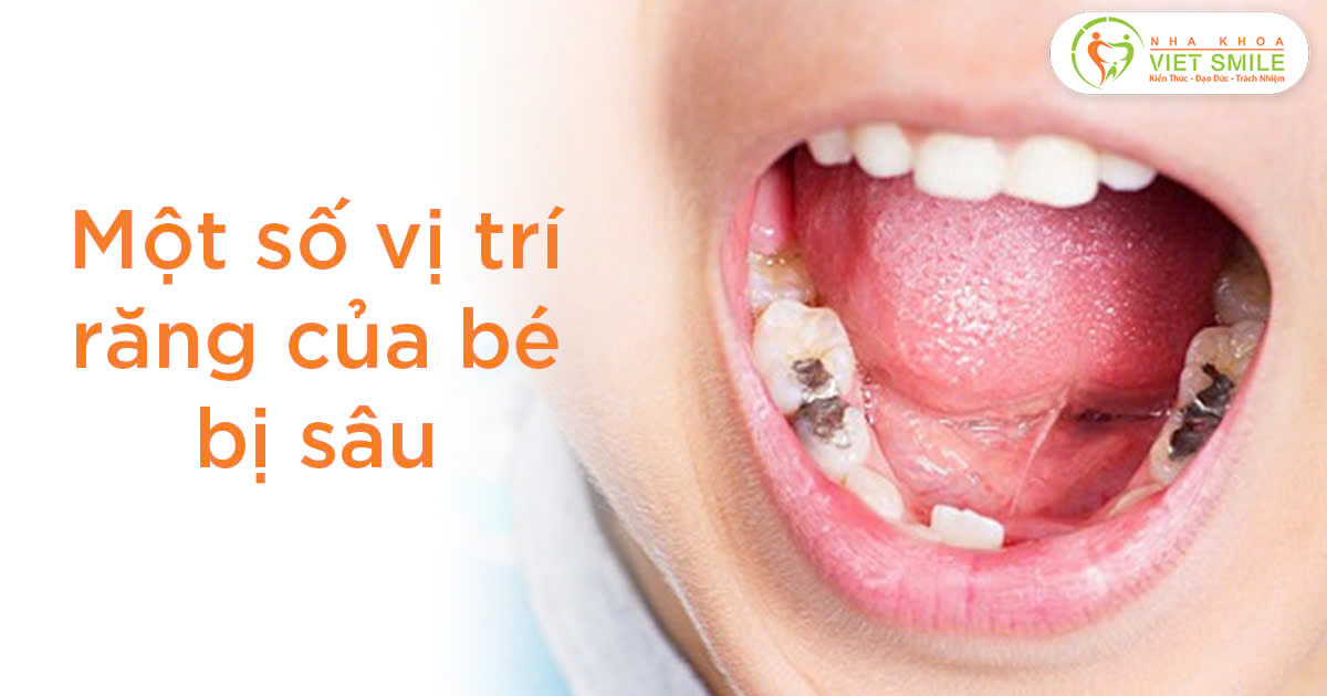 Một số vị trí răng của bé bị sâu