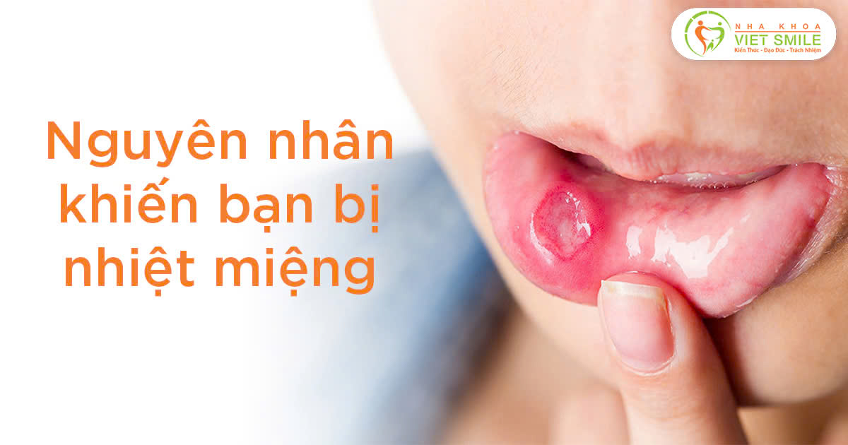 Nguyên nhân khiến bạn bị nhiệt miệng