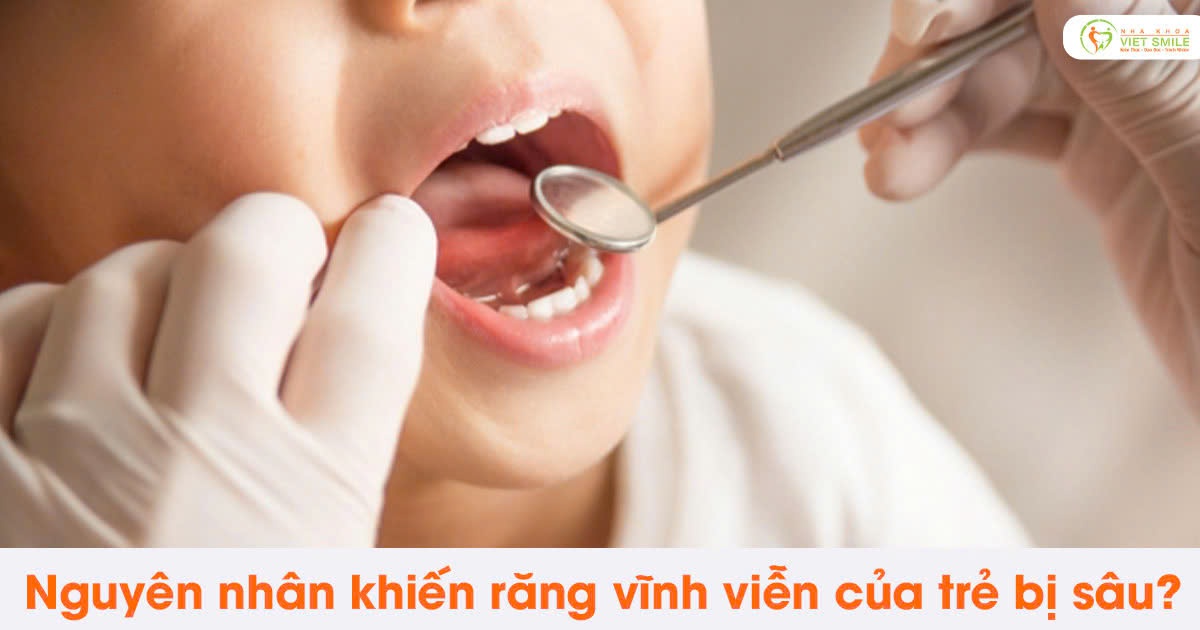 Nguyên nhân khiến răng vĩnh viễn của trẻ bị sâu?