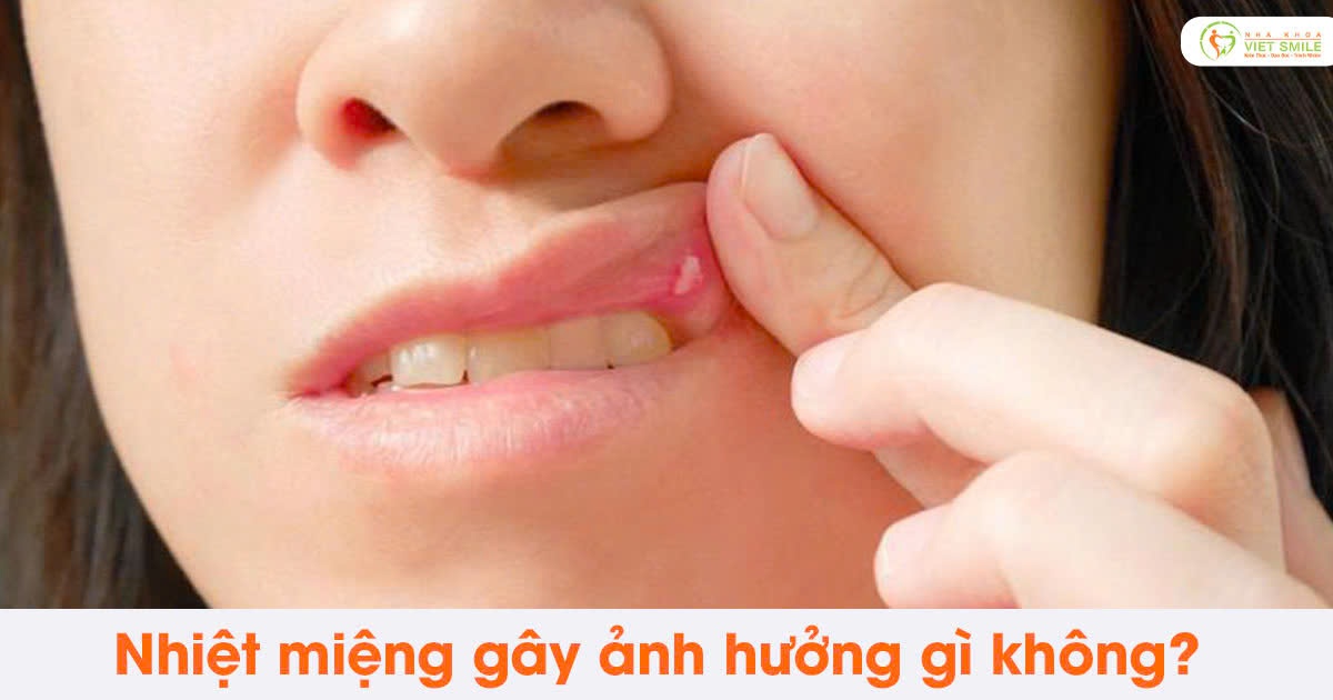 Nhiệt miệng gây ảnh hưởng gì không?