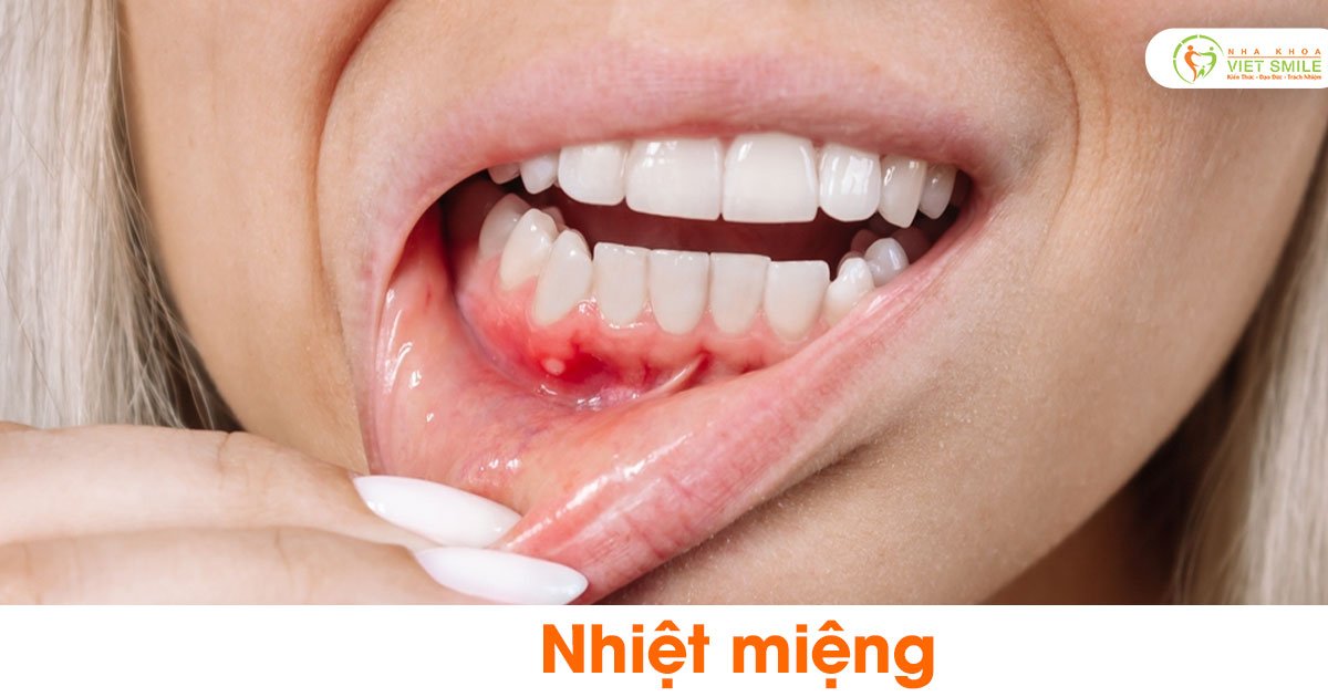 Nhiệt Miệng Uống Vitamin PP Và B2: Phương Pháp Hiệu Quả Để Nhanh Khỏi