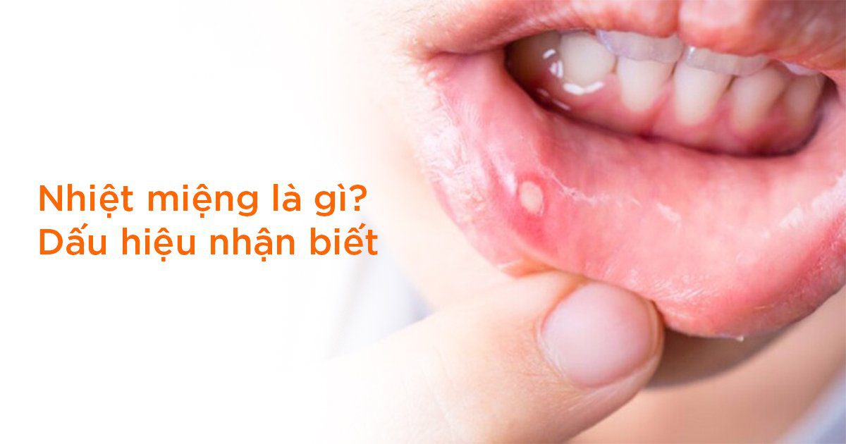 Nhiệt miệng nên uống gì nhanh khỏi tại nhà?