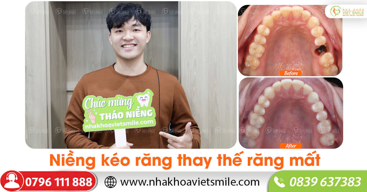 Niềng kéo răng thay thế răng mất