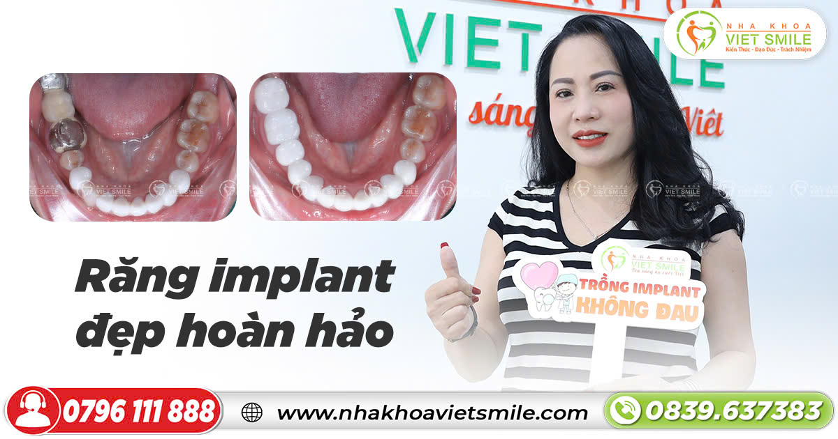 Răng implant đẹp hoàn hảo