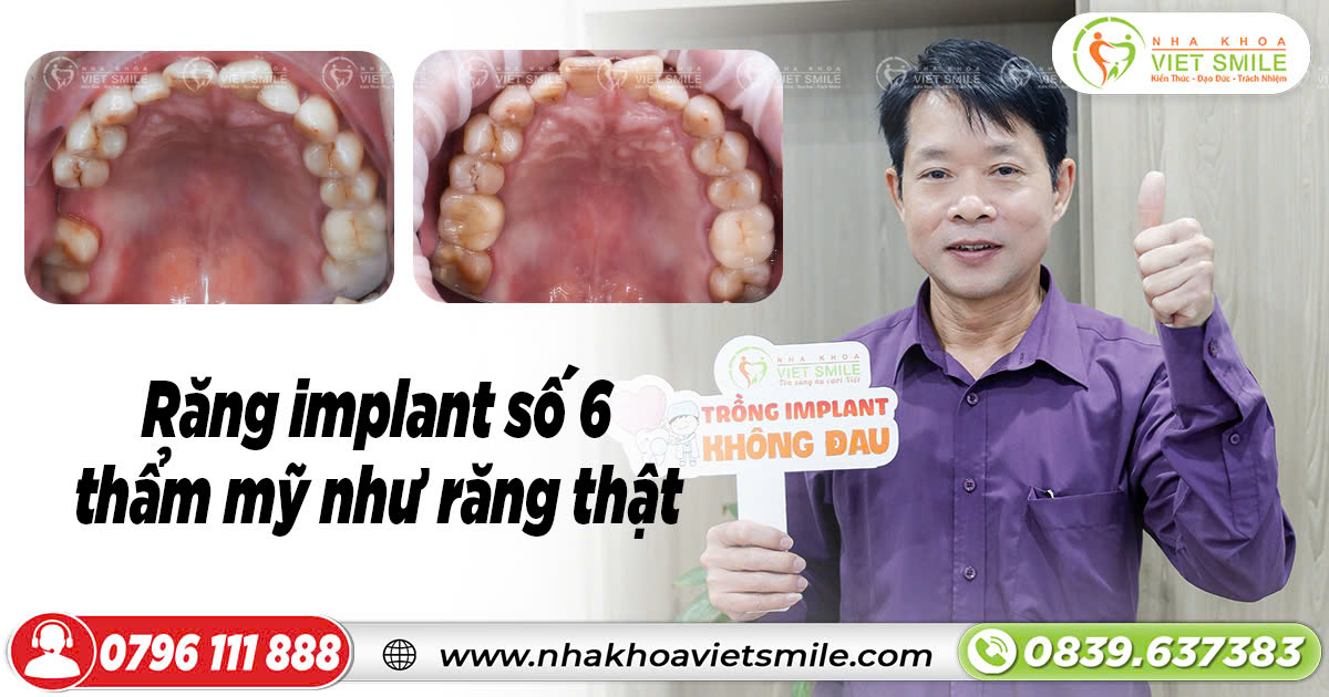 Răng implant số 6 đẹp như răng thật